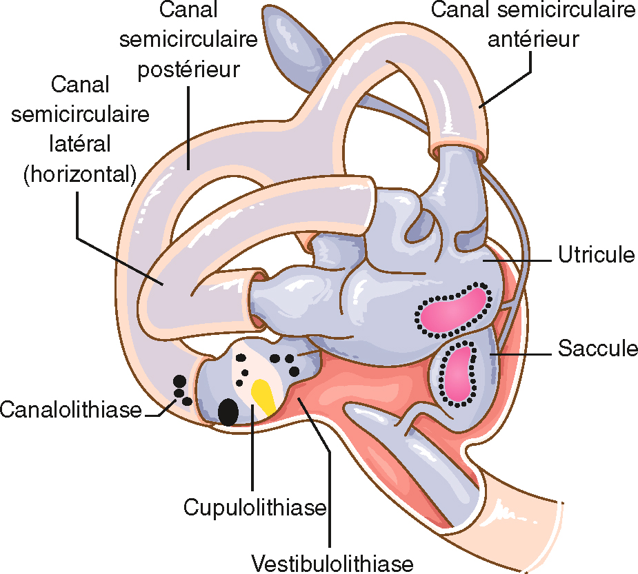 Le VPPB est un trouble causé par le déplacement des otolithes dans les canaux semi-circulaires de l'oreille interne, provoquant des vertiges lors de certains mouvements de la tête.