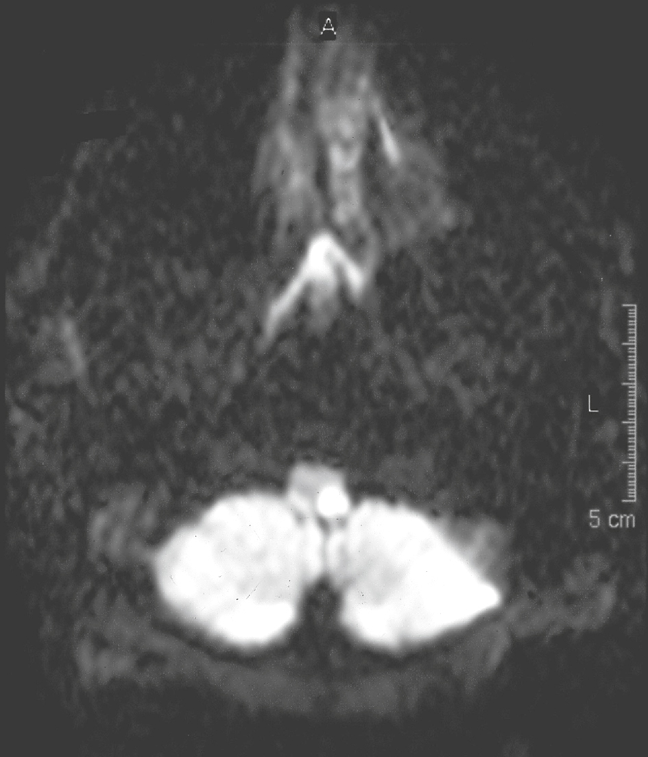 L'IRM montre une lésion ischémique récente en hypersignal dans la région latérobulbaire gauche, indiquant un infarctus cérébral aigu avec restriction de diffusion.