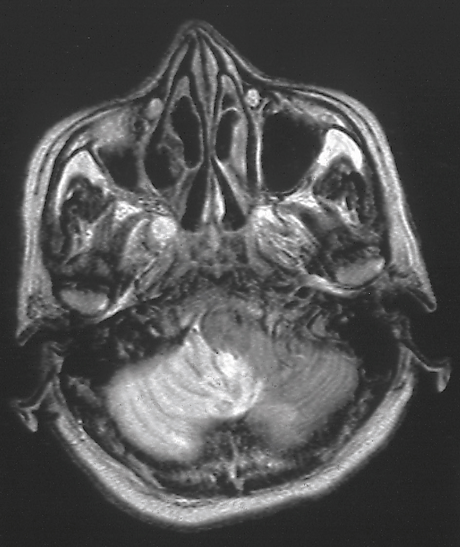 L'IRM en séquence T2 montre une lésion ischémique en hypersignal dans le territoire de l'artère cérébelleuse postéro-inférieure gauche, indiquant une zone de dommage cellulaire.