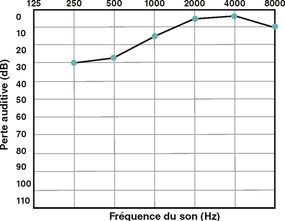 L'audiogramme montre une perte auditive (hypoacousie) marquée aux fréquences moyennes et graves, principalement entre 500 Hz et 2000 Hz, indicative de la maladie de Ménière.