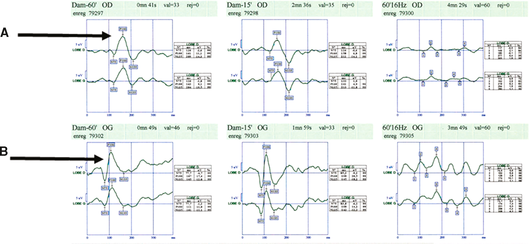 Les potentiels évoqués visuels (PEV) révèlent une latence augmentée de l'onde P100 à droite (A) par rapport à gauche (B), suggérant une anomalie du côté droit.