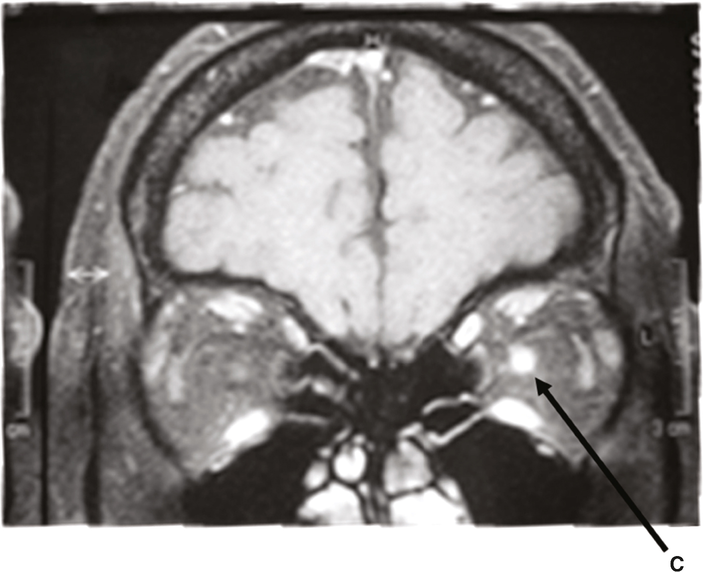 L’IRM cérébrale T1 avec gadolinium montre un hypersignal du nerf optique gauche (flèche rouge), suggérant une inflammation ou une lésion, avec impact possible sur la vision.