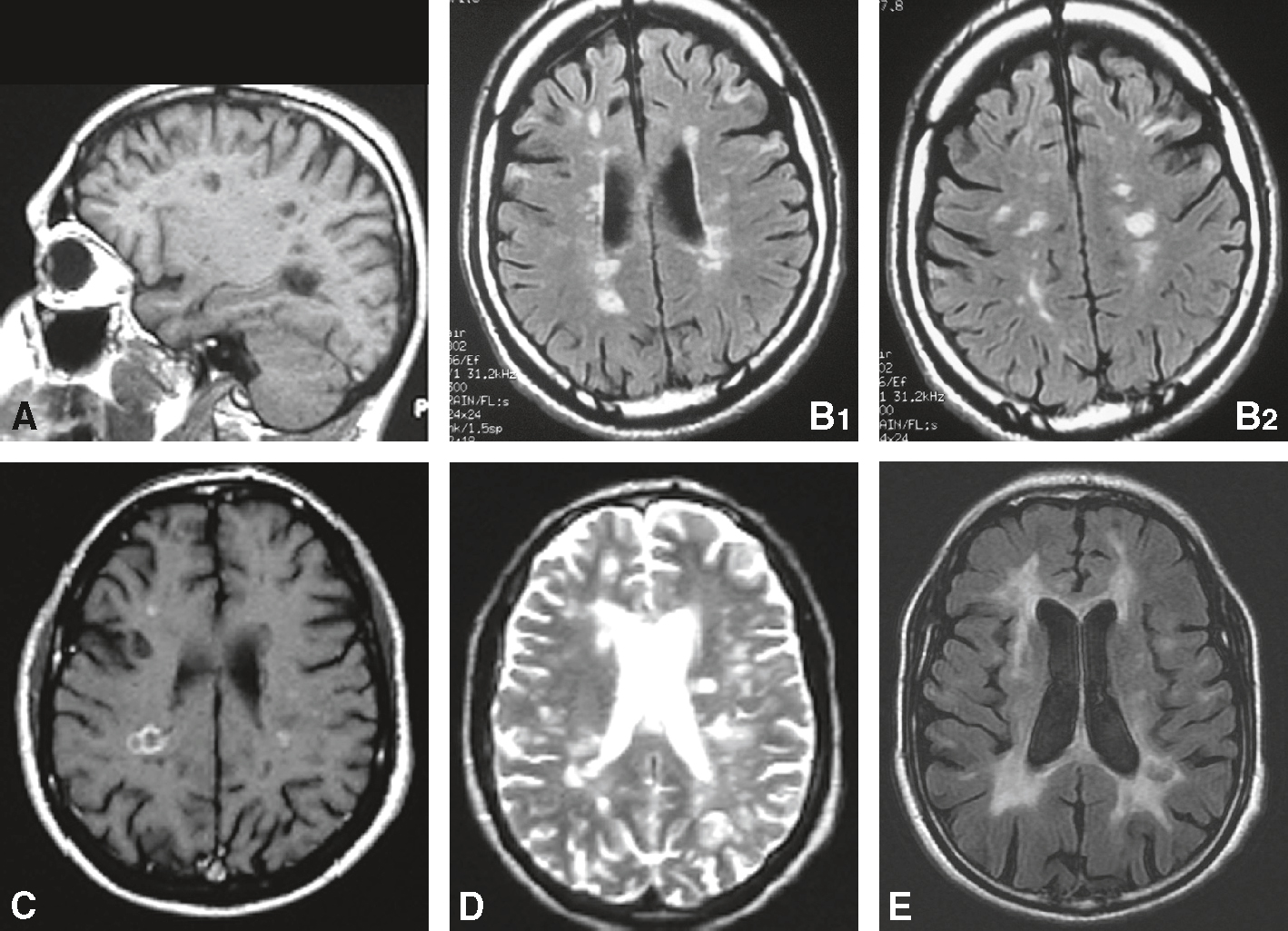 L'IRM cérébrale dans la SEP montre des lésions hyperintenses en FLAIR (plaques de démyélinisation), des lésions actives en T1 post-gadolinium et une atrophie avec élargissement ventriculaire.