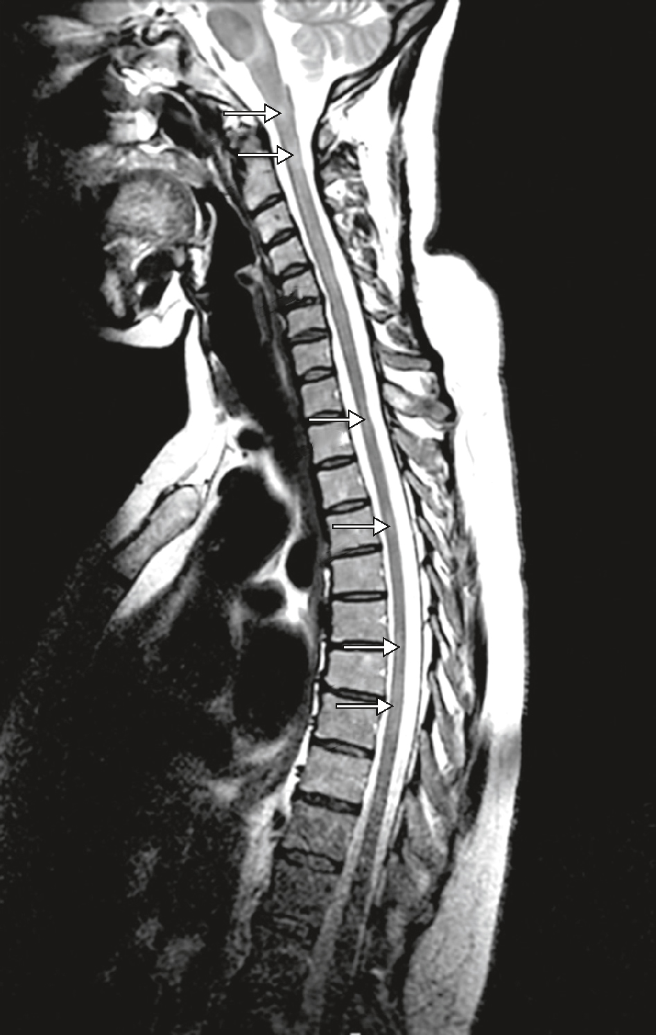 L'IRM médullaire dans la SEP révèle des lésions hyperintenses en zones de démyélinisation, essentielles pour diagnostiquer, suivre l'évolution et ajuster les traitements.