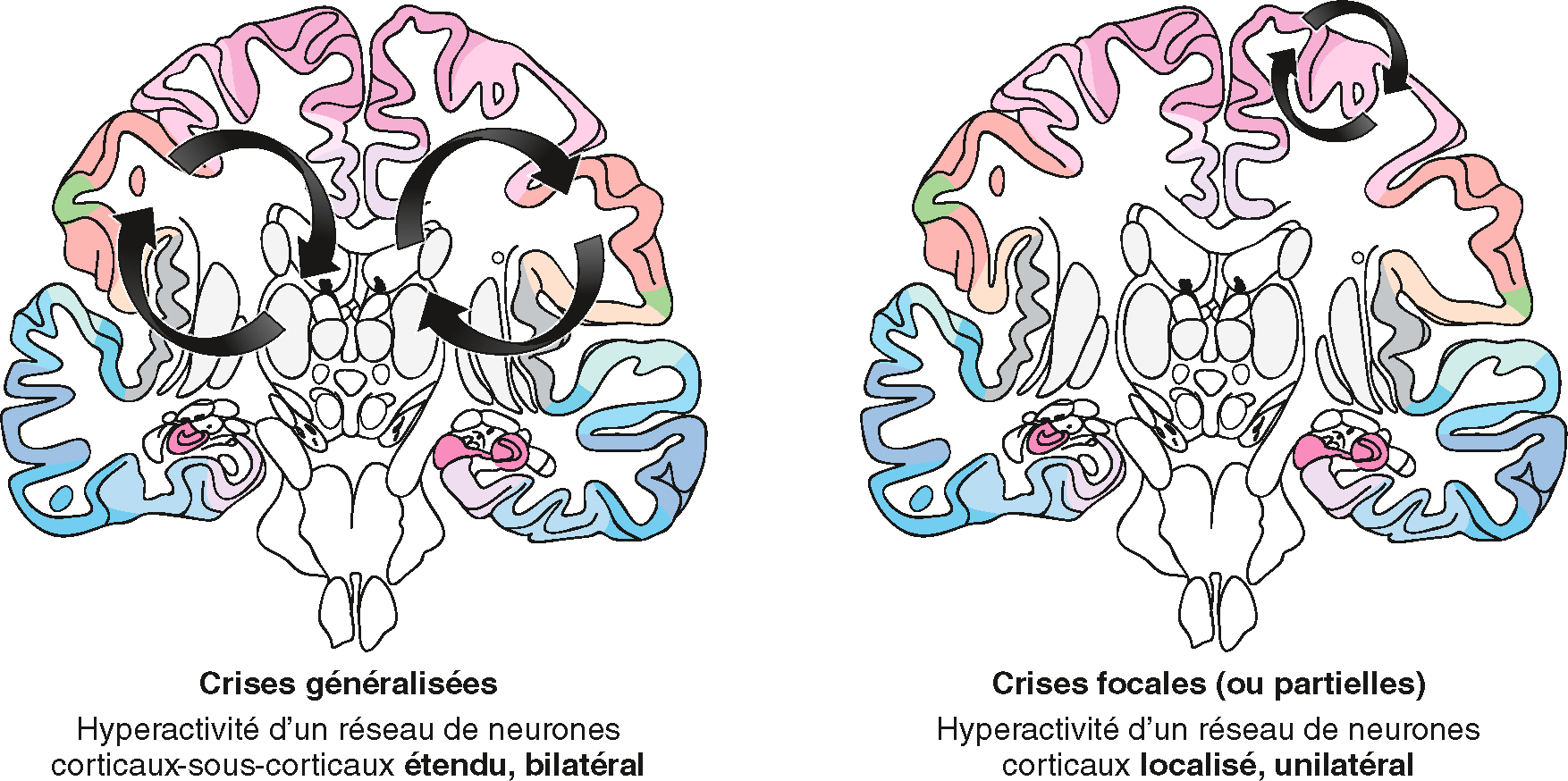 Les crises généralisées touchent les deux hémisphères du cerveau dès le début, tandis que les crises focales commencent dans une région spécifique et peuvent se propager.