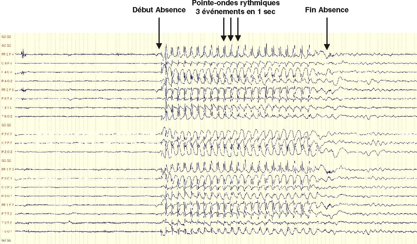 L'EEG montre des pointes-ondes rythmiques à 3 Hz, typiques des crises d'absence, marquant la perte de conscience et aidant au diagnostic de ce type d'épilepsie.