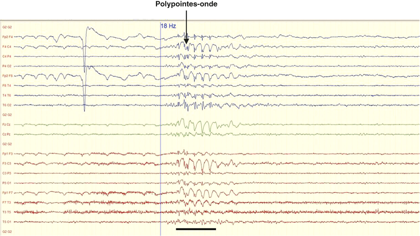 L'EEG montre des polypointes-ondes généralisées à 18 Hz, visibles sur plusieurs canaux, suggérant une activité épileptique généralisée, utile pour le diagnostic neurologique.