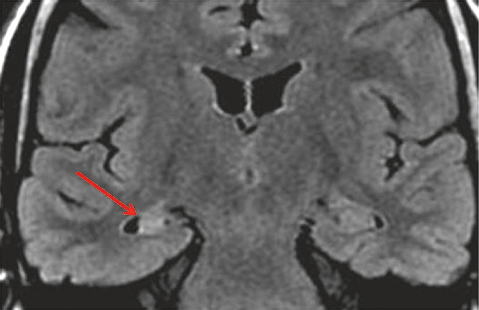 L'IRM en FLAIR montre une atrophie et une sclérose de l'hippocampe droit (hypersignal), signes d'épilepsie temporale médiale, cruciale pour un diagnostic précis.