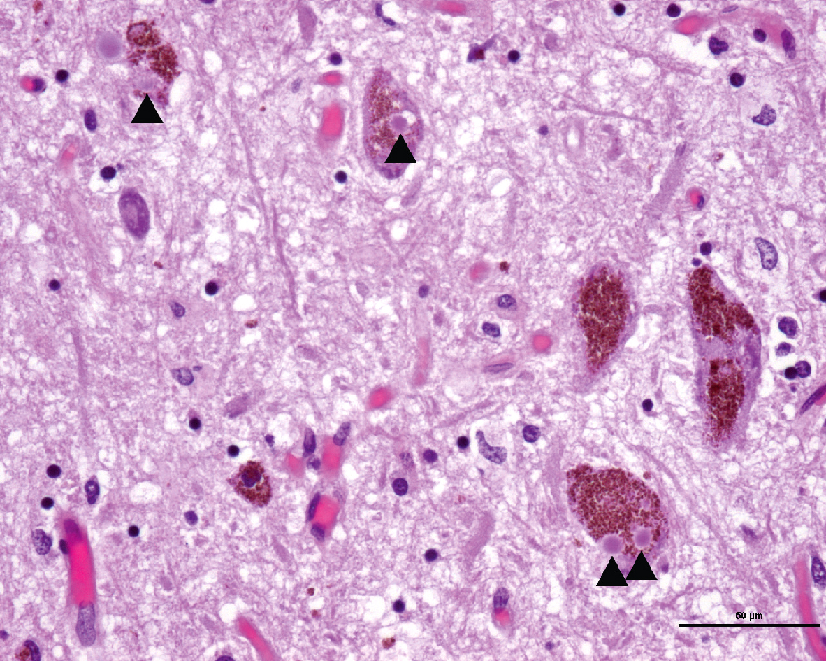 Les corps de Lewy dans les neurones dopaminergiques de la substance noire, observés dans la maladie de Parkinson, sont des marqueurs pathologiques caractéristiques de cette maladie.