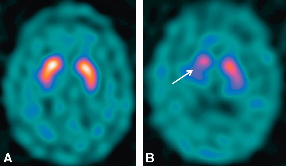 La scintigraphie cérébrale DaTSCAN montre une réduction des transporteurs de dopamine dans le striatum chez les patients parkinsoniens, facilitant le diagnostic.