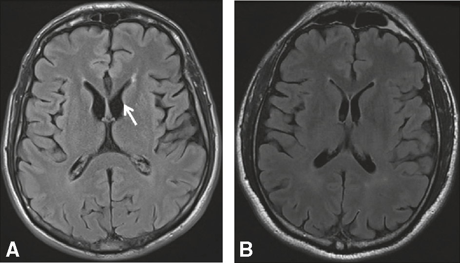 Les images IRM montrent une atrophie du noyau caudé, caractéristique de la maladie de Huntington, une maladie neurodégénérative affectant les capacités motrices et cognitives.