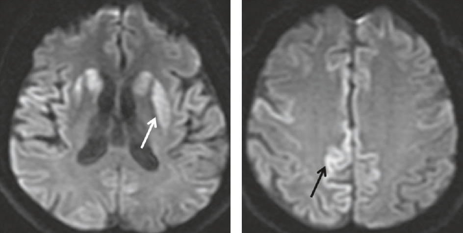 Les hypersignaux du putamen gauche et du cortex sur l'IRM, caractéristiques de la maladie de Creutzfeldt-Jakob, signalent des lésions cérébrales dans les régions motrices et cognitives.