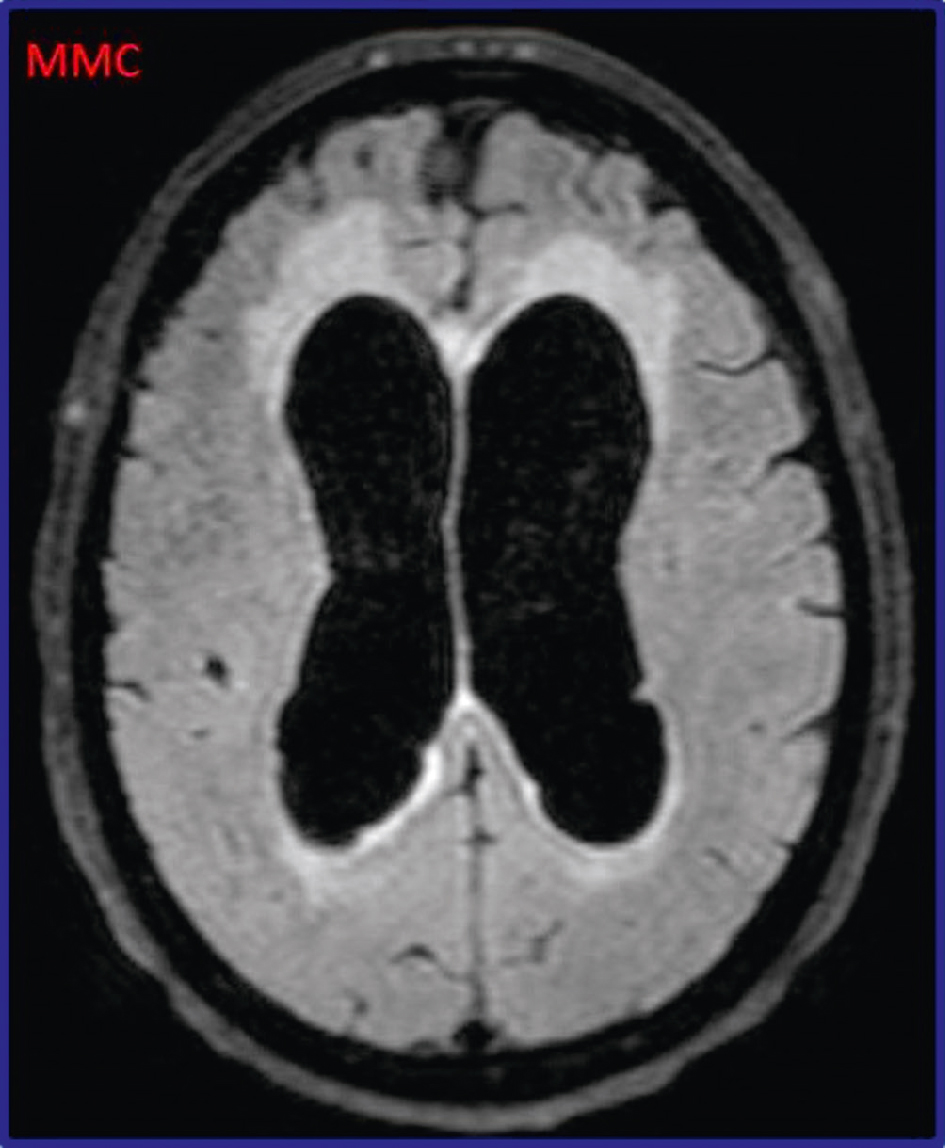 IRM montrant une dilatation ventriculaire symétrique, compatible avec une hydrocéphalie chronique à pression normale.