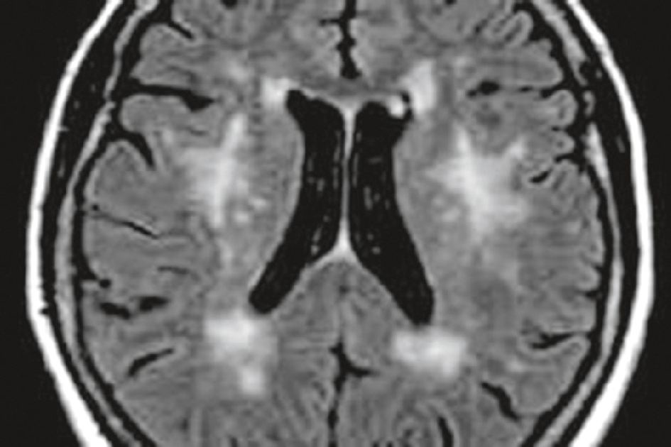 IRM cérébrale montrant des hypersignaux lacunaires multiples, compatibles avec un état lacunaire d’origine microangiopathique chronique.