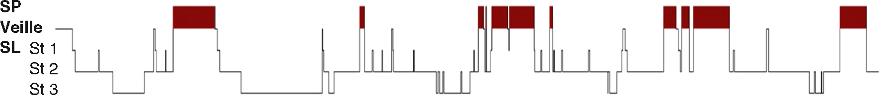 L'hypnogramme montre les différentes phases de sommeil : veille, sommeil léger (ST1, ST2), sommeil profond (ST3) et sommeil paradoxal (SP), avec des transitions cycliques.