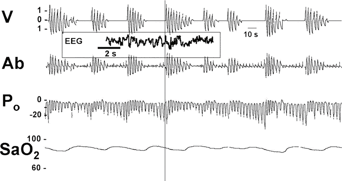 L'image montre un enregistrement polygraphique du sommeil d'un patient avec apnées du sommeil : pauses respiratoires, mouvements interrompus et baisse de la saturation en oxygène.