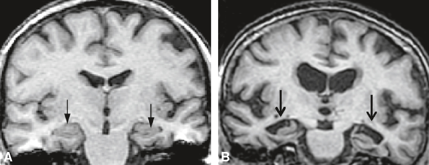 L'IRM cérébrale montre des signes d'atrophie hippocampique, un indicateur clé de la maladie d'Alzheimer, à travers des coupes coronales du cerveau.