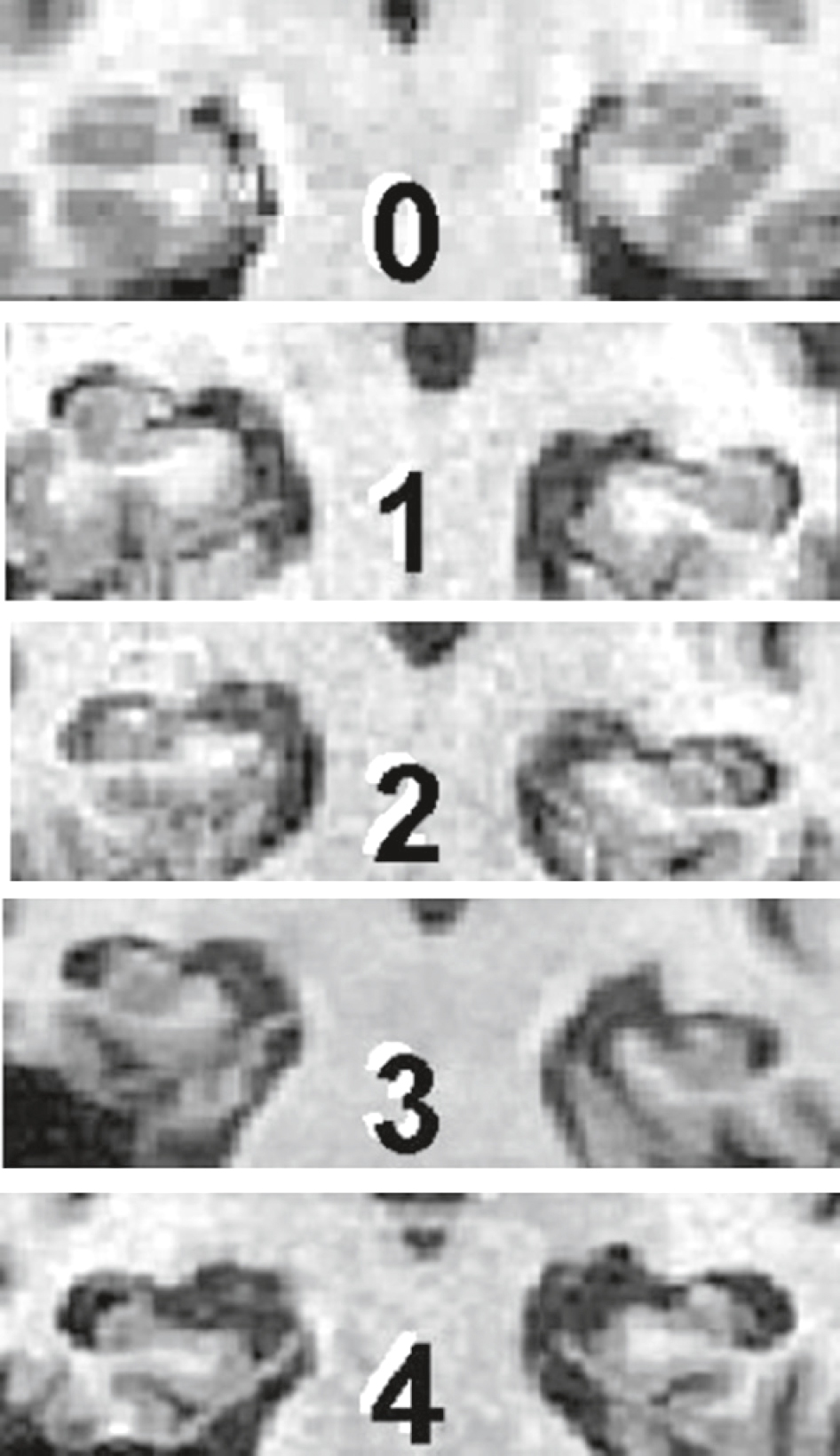L'échelle de Scheltens évalue l'atrophie cérébrale, de l'absence à une atrophie sévère, permettant de suivre l'évolution de maladies neurodégénératives comme Alzheimer.