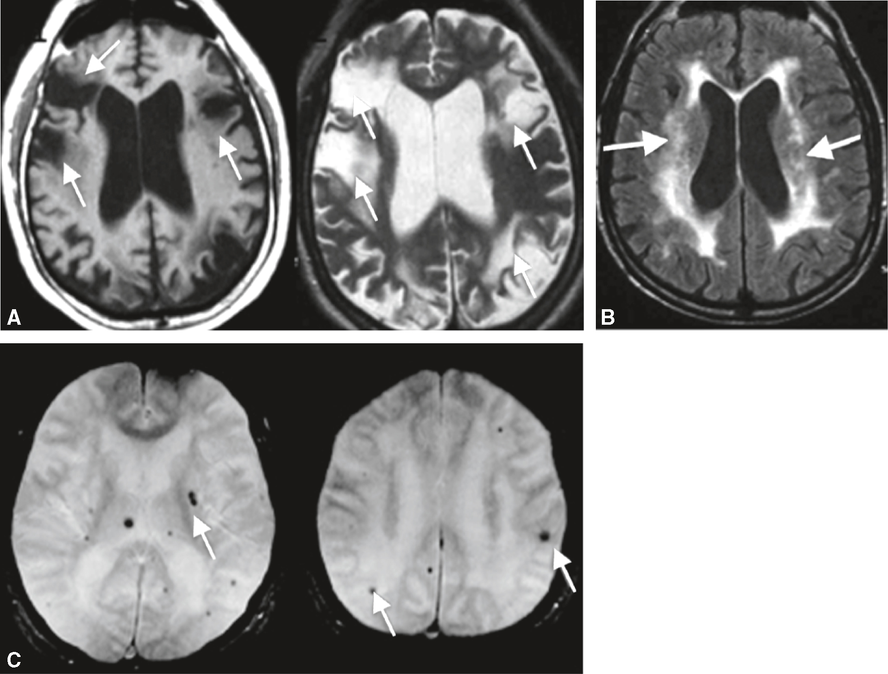 Les images montrent des lésions vasculaires cérébrales détectées par IRM : lésions hyperintenses, leucoaraïose et microhémorragies, associées à des troubles cognitifs.