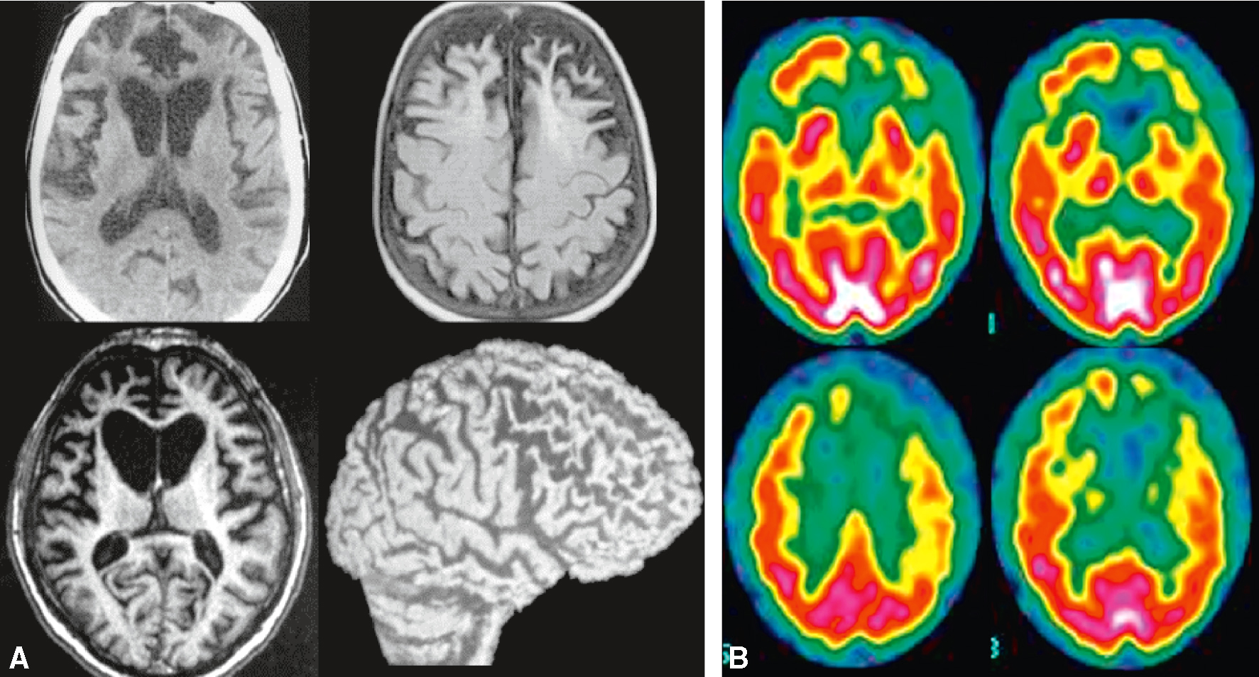 Les images montrent l'atrophie des lobes frontaux et temporaux en IRM et une réduction de l'activité métabolique en TEP, caractéristiques de la démence frontotemporale.