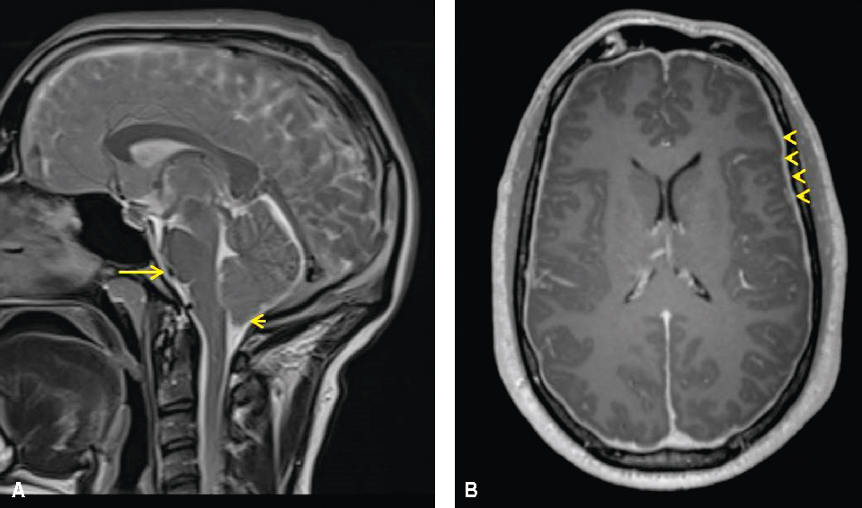 Les images IRM montrent des signes de syndrome post-ponction lombaire avec hypotension du LCS, indiquant des anomalies dans les structures cérébrales dues à la perte de LCS.