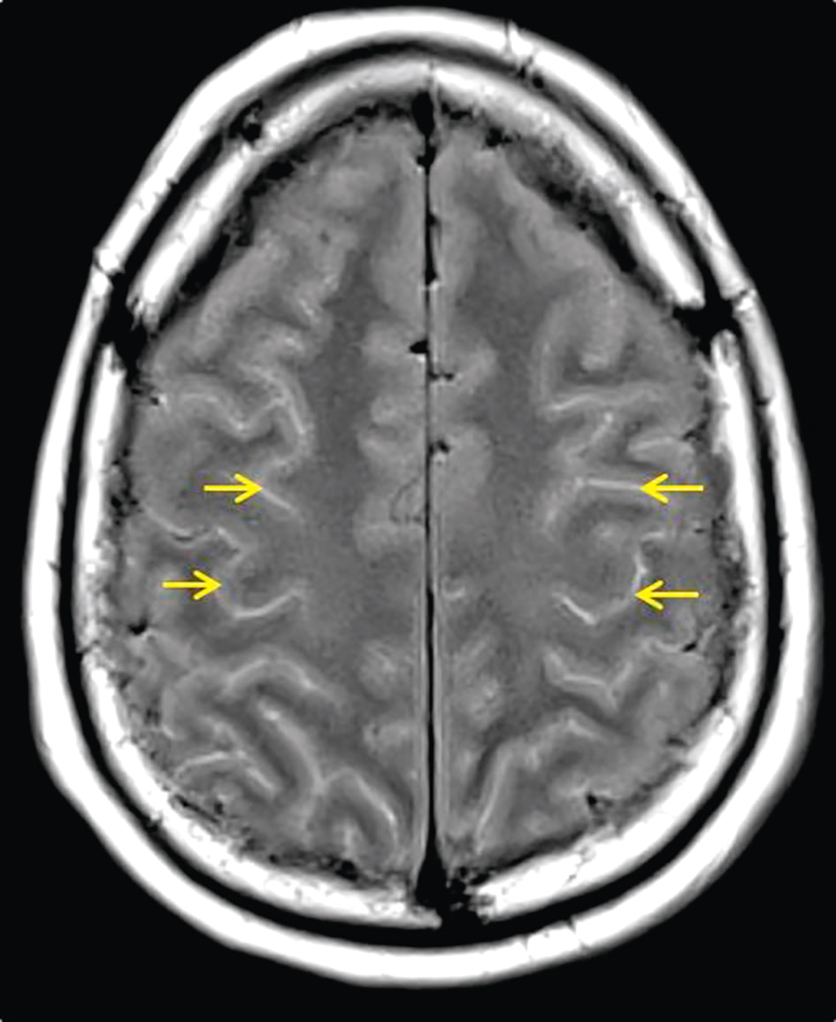 Les hypersignaux des sillons corticaux sur l'IRM en séquence FLAIR suggèrent une inflammation liée à une méningite à pneumocoque, essentielle pour le diagnostic et le suivi.