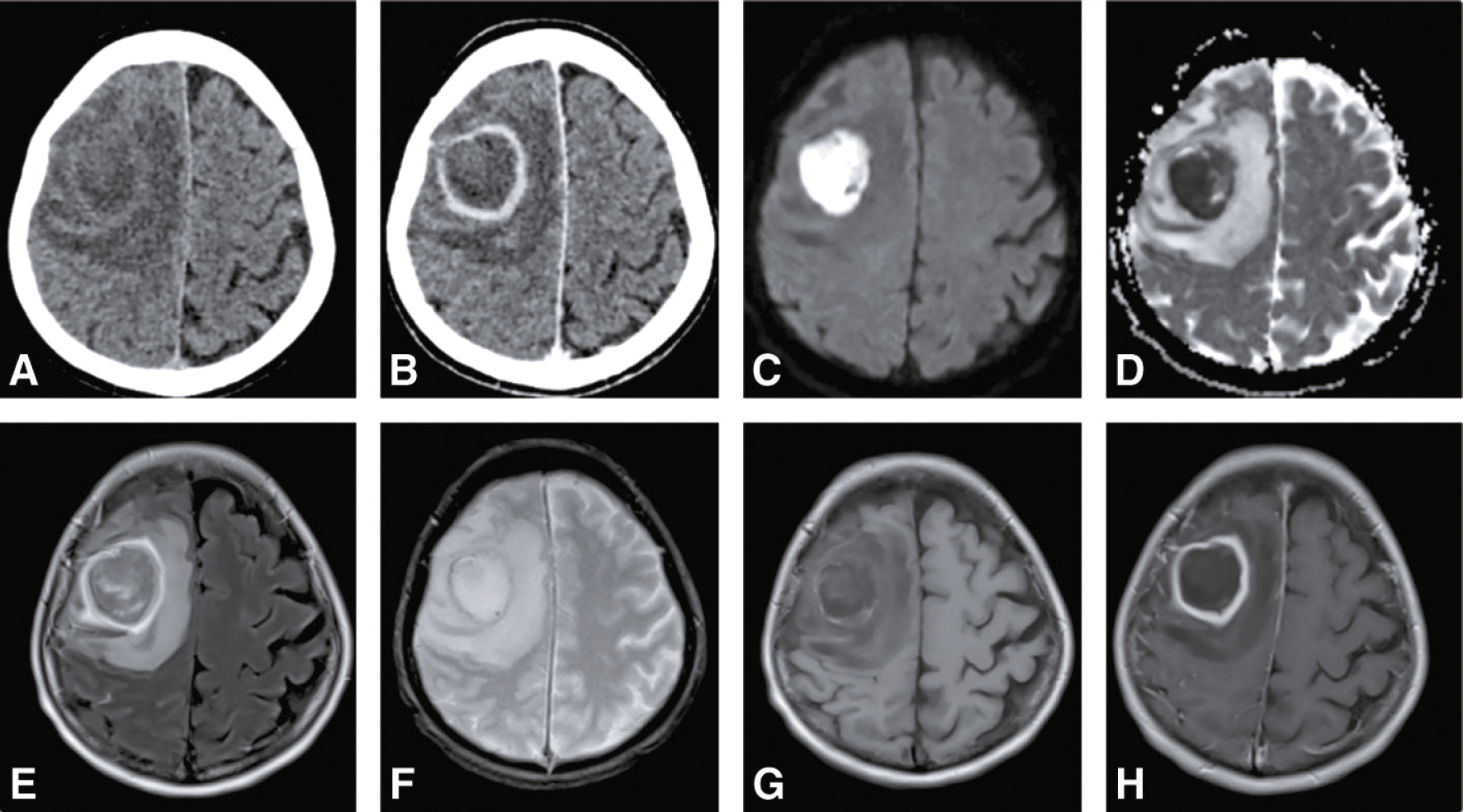Les images montrent un abcès cérébral frontal droit, diagnostiqué grâce à un scanner et à plusieurs séquences IRM, incluant T1 avec gadolinium, diffusion et FLAIR.
