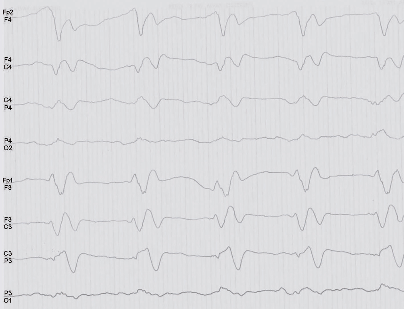 L'EEG montre des ondes lentes périodiques diffuses, caractéristiques d'une encéphalite, perturbant l'activité électrique cérébrale, et cruciales pour le diagnostic et le traitement.