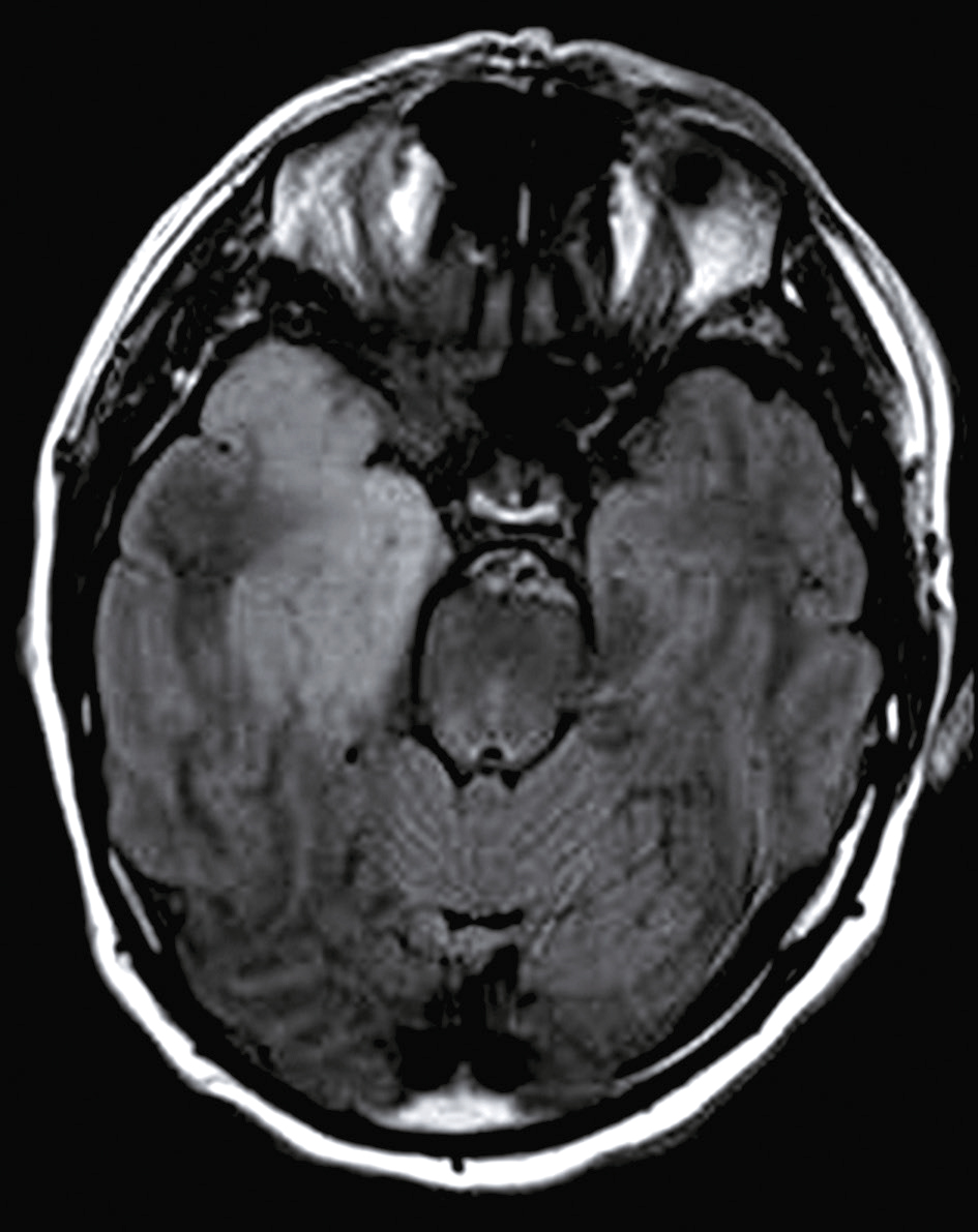 L'IRM en séquence FLAIR montre des zones hyperintenses dans le lobe temporal, caractéristiques d'une méningo-encéphalite herpétique, essentielles pour le diagnostic et le traitement.
