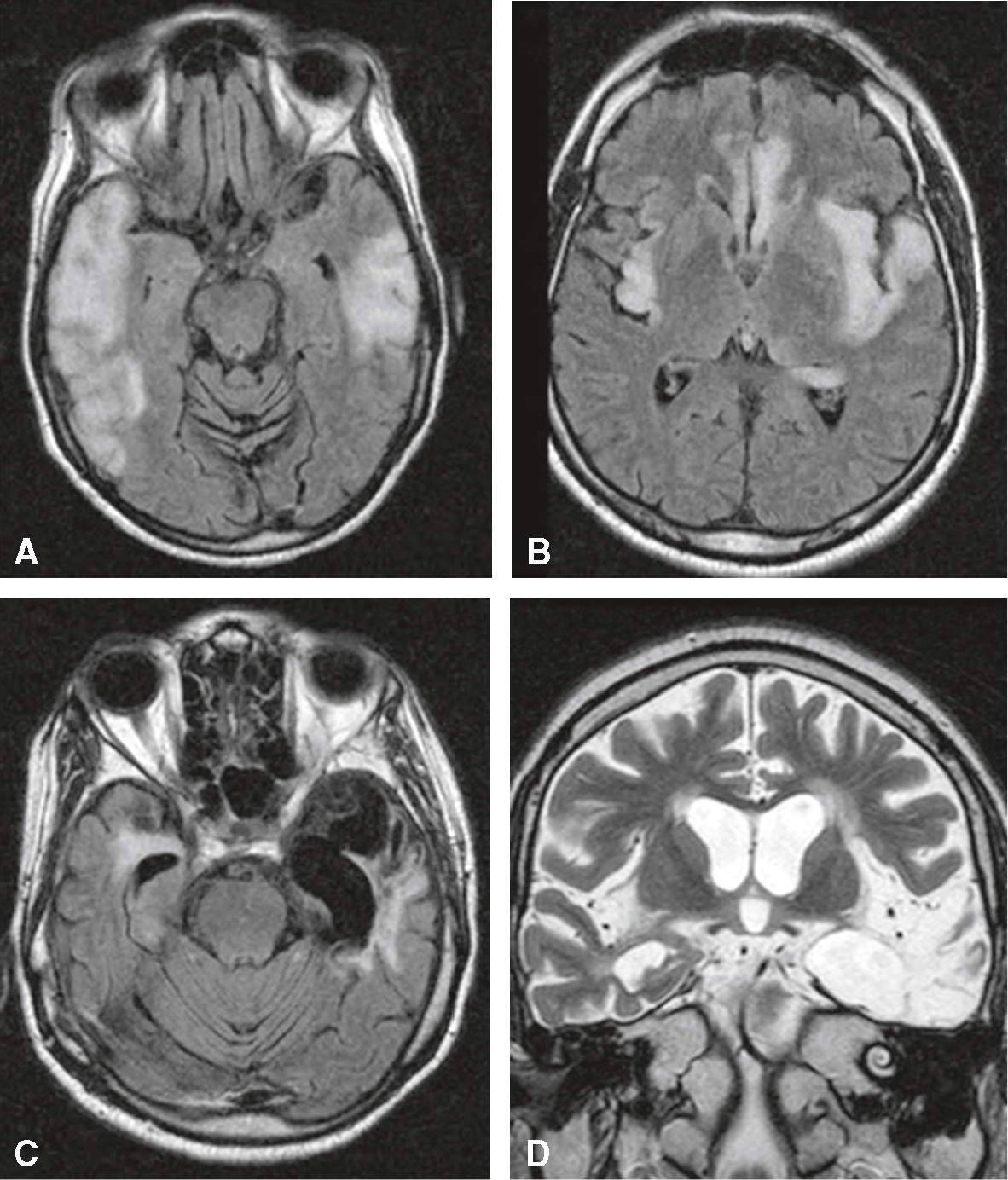 L'IRM cérébrale montre des anomalies dans les lobes temporaux et frontaux, indiquant une encéphalite herpétique avec inflammation et œdème, confirmant le diagnostic.