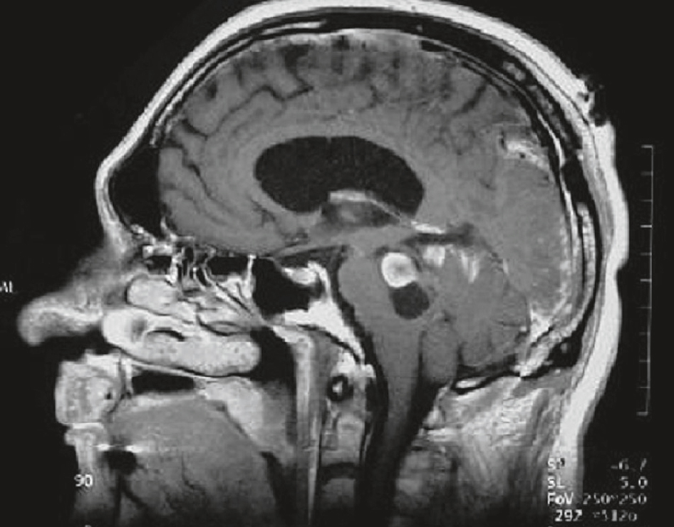 IRM montrant une masse au niveau du tronc cérébral avec effet de masse et signes compressifs, évoquant une HTIC chez un patient de 22 ans.