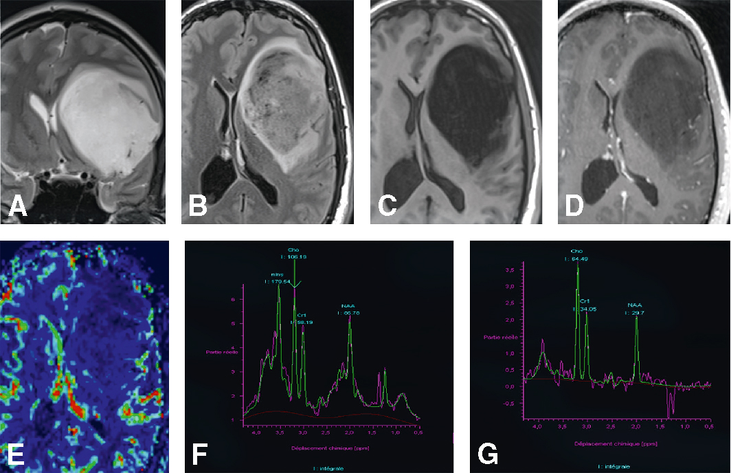 IRM révélant une tumeur fronto-pariétale avec rehaussement périphérique, hyperperfusion et profil spectroscopique évocateur d’un gliome de haut grade.