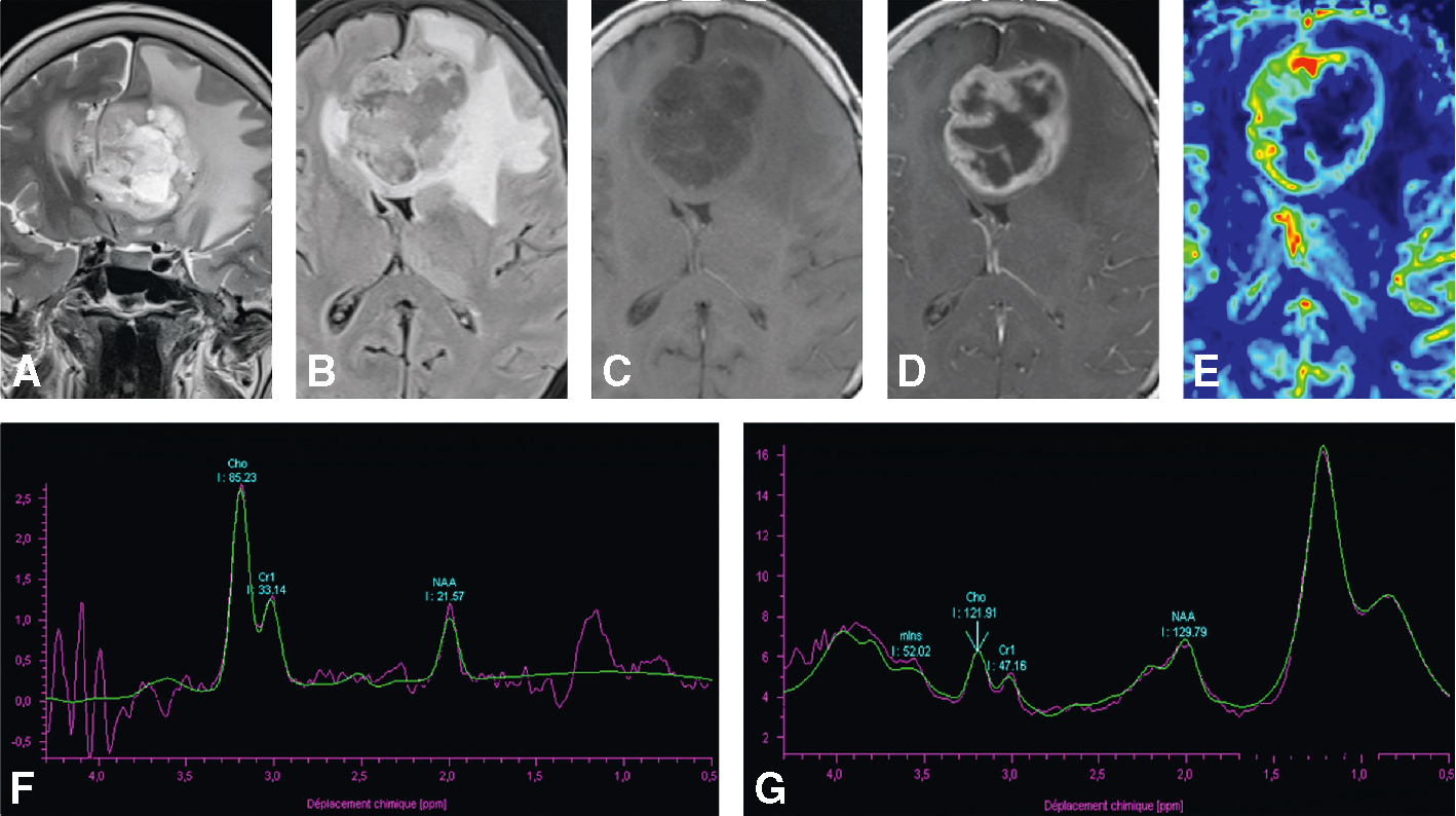 IRM montrant une masse cérébrale avec œdème et rehaussement annulaire, spectroscopie en faveur d’un glioblastome.