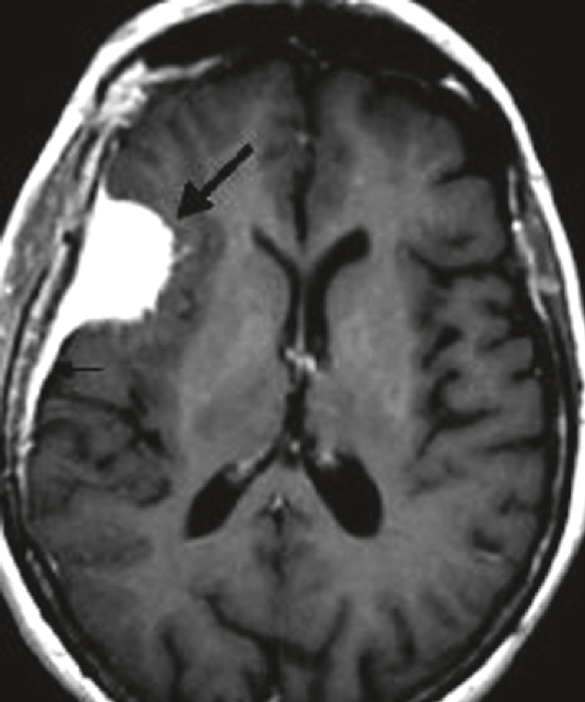 Masse frontale gauche avec œdème et effet de masse, évoquant un gliome chez une patiente épileptique de 54 ans.
