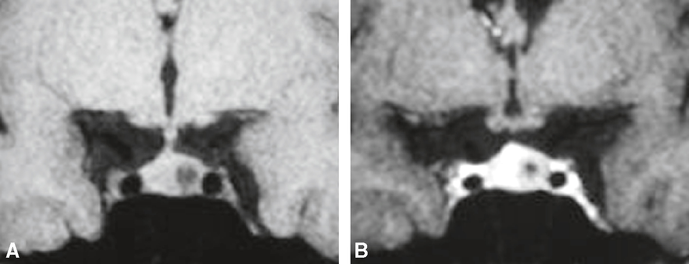 IRM T1 avant et après gadolinium montrant un rehaussement inhomogène hypophysaire. Aspect évocateur d’un microadénome chez une patiente hyperprolactinémique.