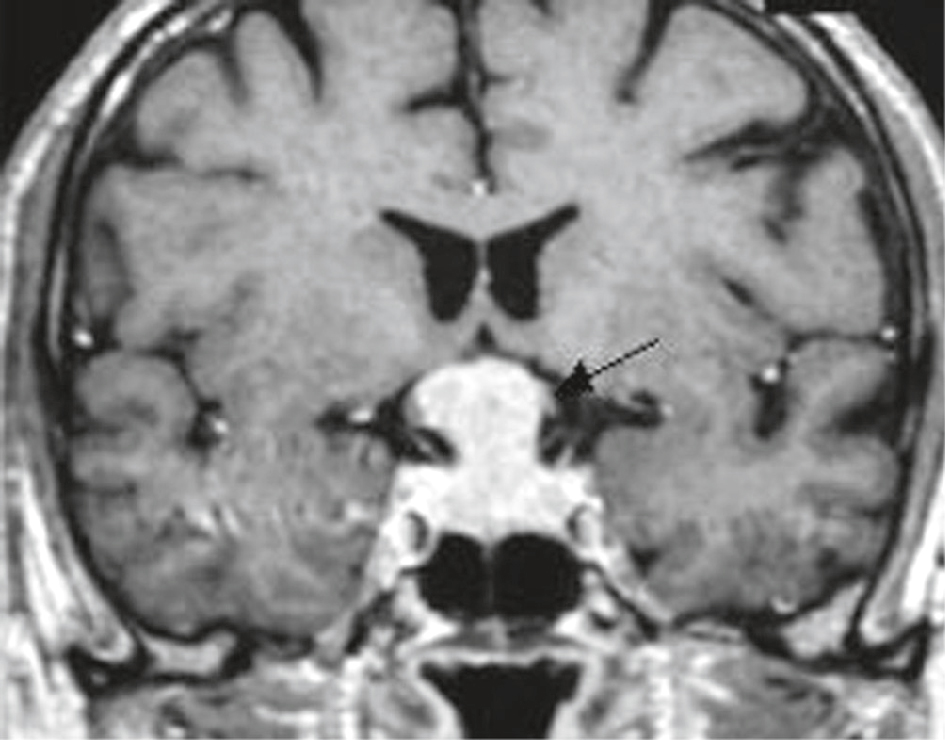 IRM montrant une lésion sellarienne comprimant le chiasma optique chez une patiente de 57 ans avec hémianopsie bitemporale. Aspect en faveur d’un adénome.