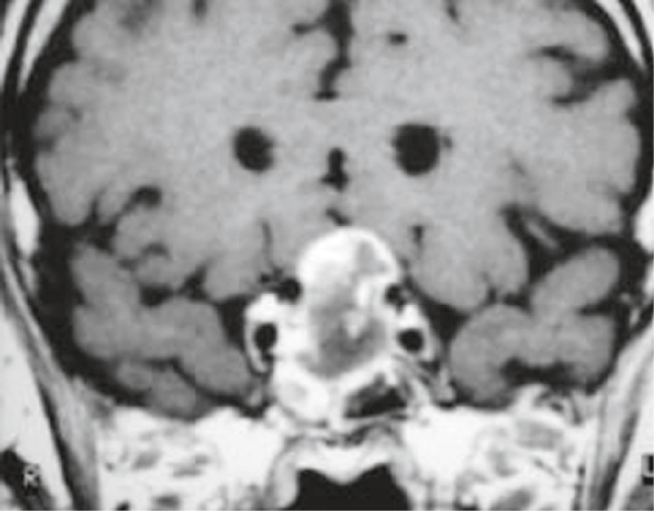 IRM montrant une masse suprasellaire comprimant le chiasma optique, expliquant l’hémianopsie bitemporale chez un homme de 72 ans.