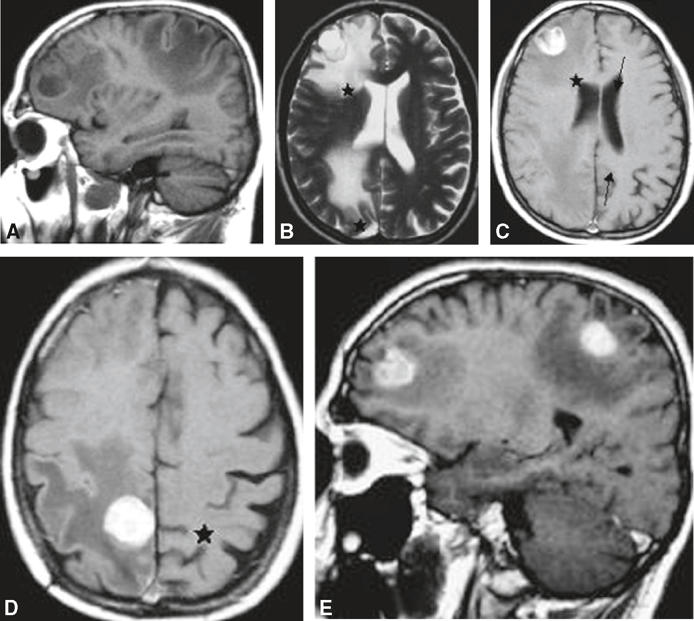 IRM cérébrale montrant métastases frontales droites avec œdème. Trouvailles compatibles avec adénocarcinome bronchique métastasé.