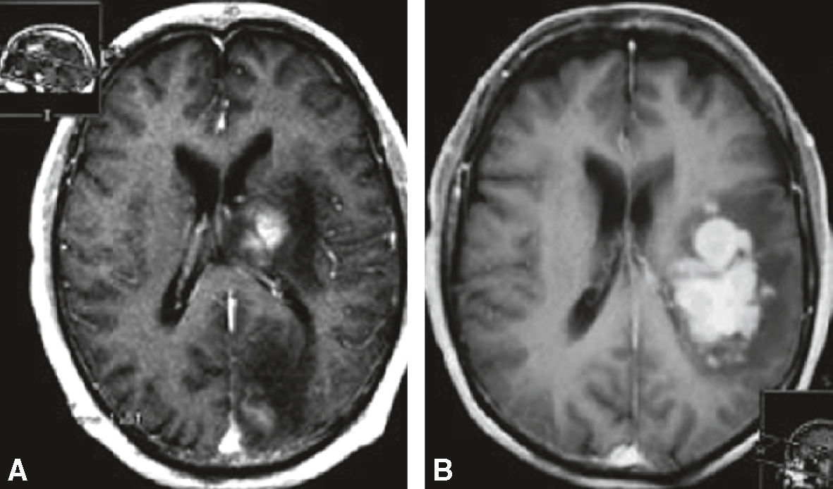 IRM montrant des lésions paraventriculaires avec prise de contraste homogène, évocatrices de lymphome ou d’infection opportuniste en contexte immunodéprimé.