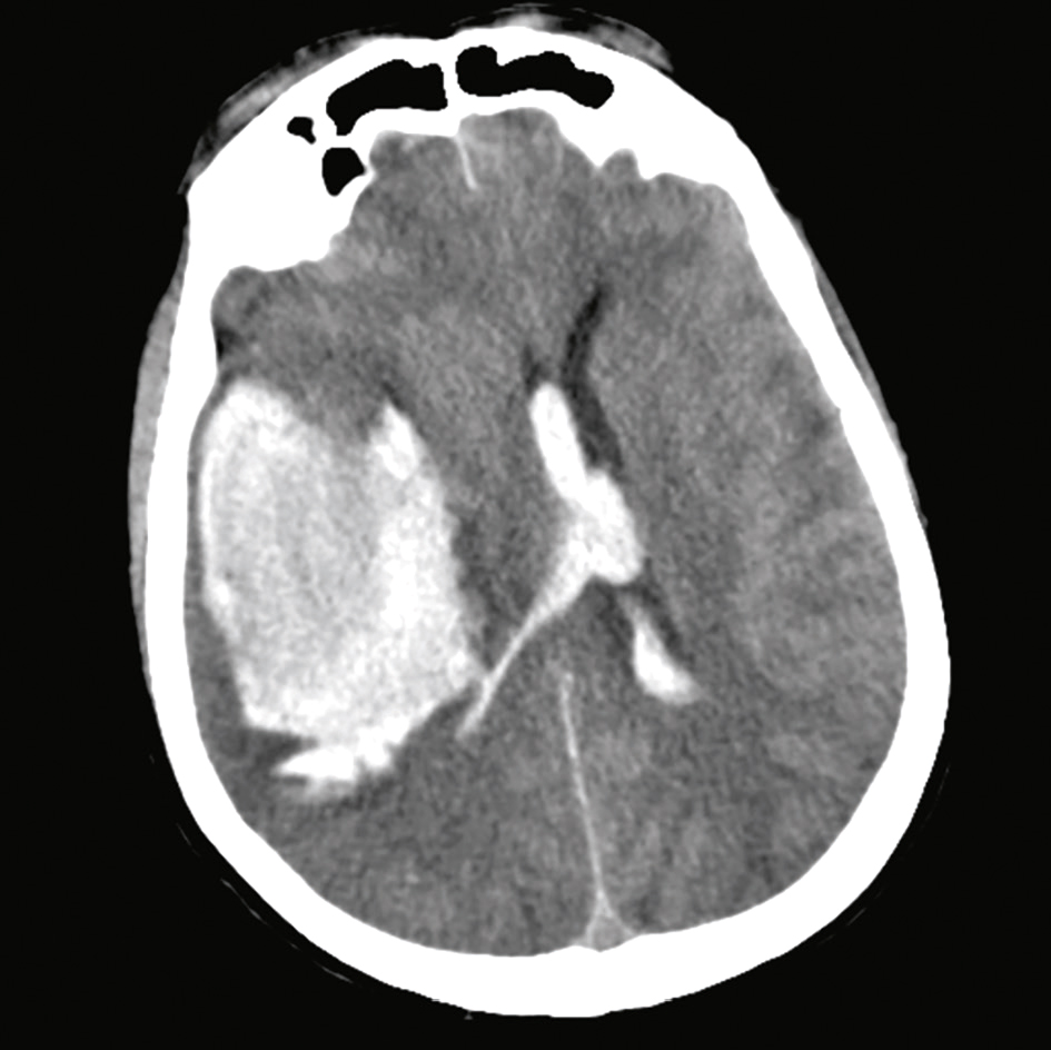 L'hémorragie centro-hémisphérique droite provoque une pression sur le cerveau, déplaçant ses structures. Cela peut entraîner un engagement cérébral, nécessitant une intervention urgente.