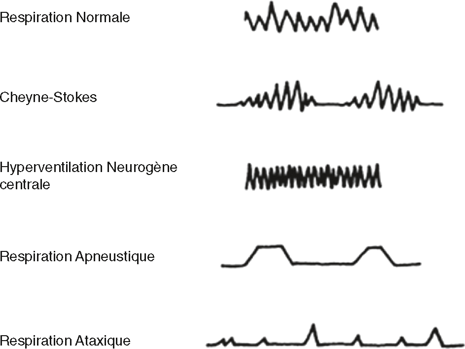 L'image montre des types de dyspnée, incluant la respiration normale, Cheyne-Stokes, hyperventilation neurogène, apneustique et ataxique, indiquant des troubles neurologiques graves.