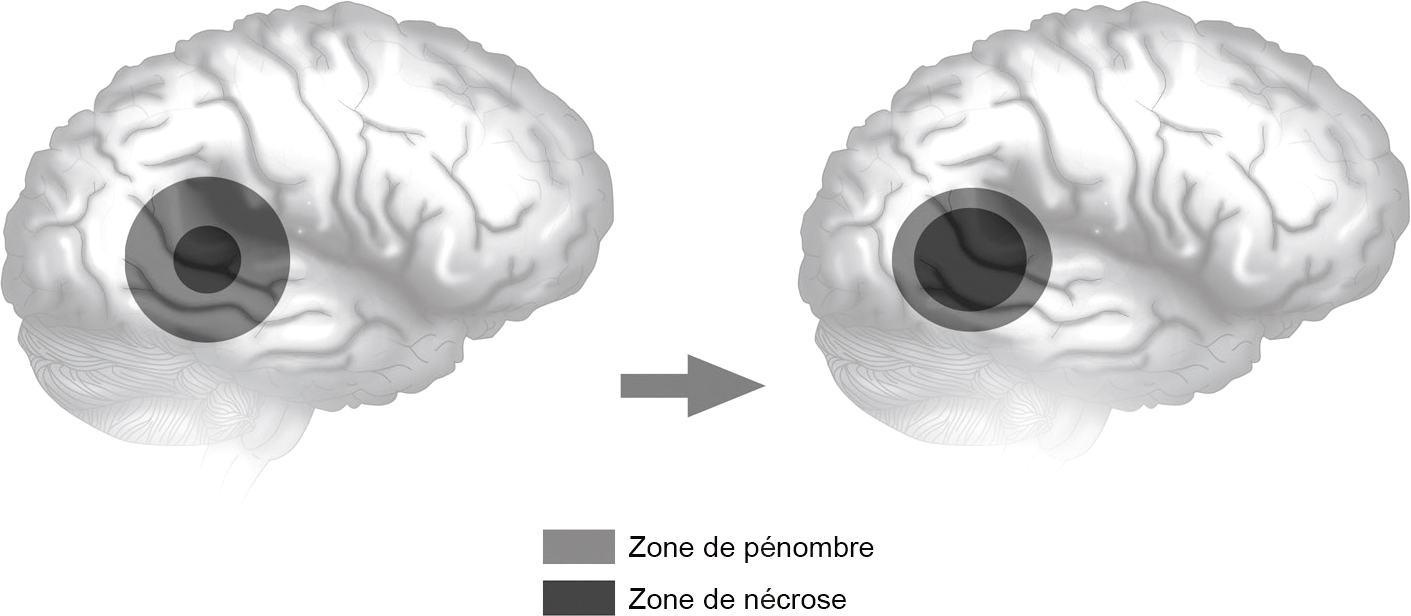 L'image illustre l'évolution de l'ischémie cérébrale sans recanalisation, montrant l'extension de la nécrose et la réduction de la zone récupérable, soulignant l'urgence d'une intervention.