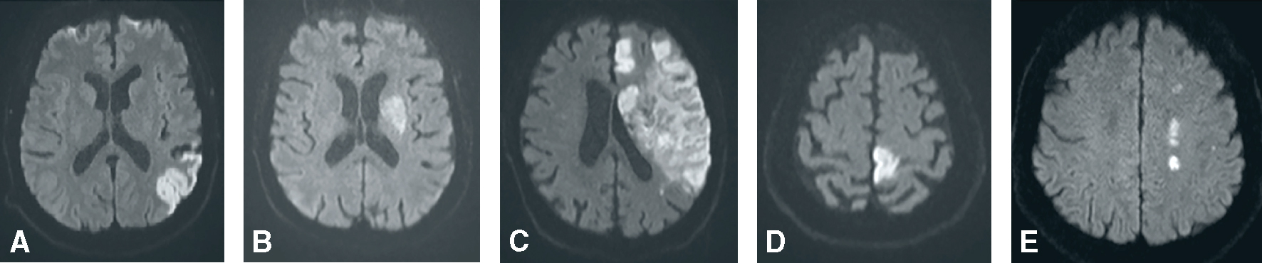 Les orientations diagnostiques d'AVC se divisent en transitoire (AIT probable ou possible) et persistant (infarctus ou hémorragie). Différentiels : migraine, hypoglycémie, etc.