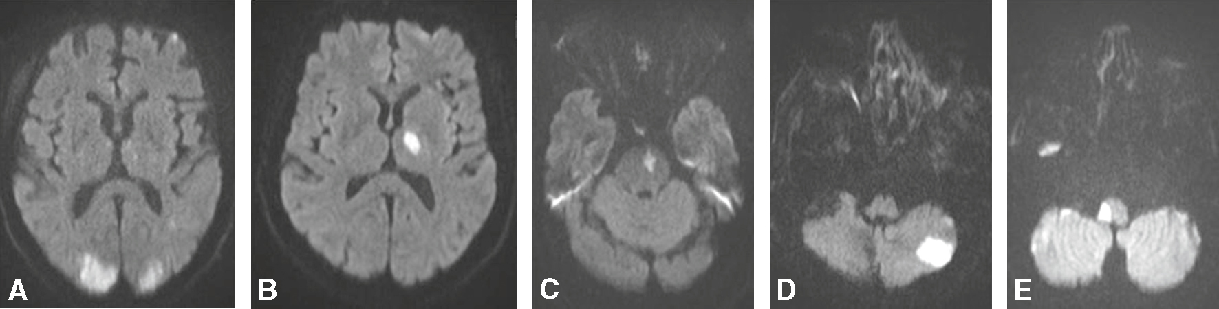 L'infarctus de la circulation antérieure prive le cerveau d'oxygène. Les images IRM montrent des zones affectées, indiquant des dommages cérébraux nécessitant une intervention rapide.