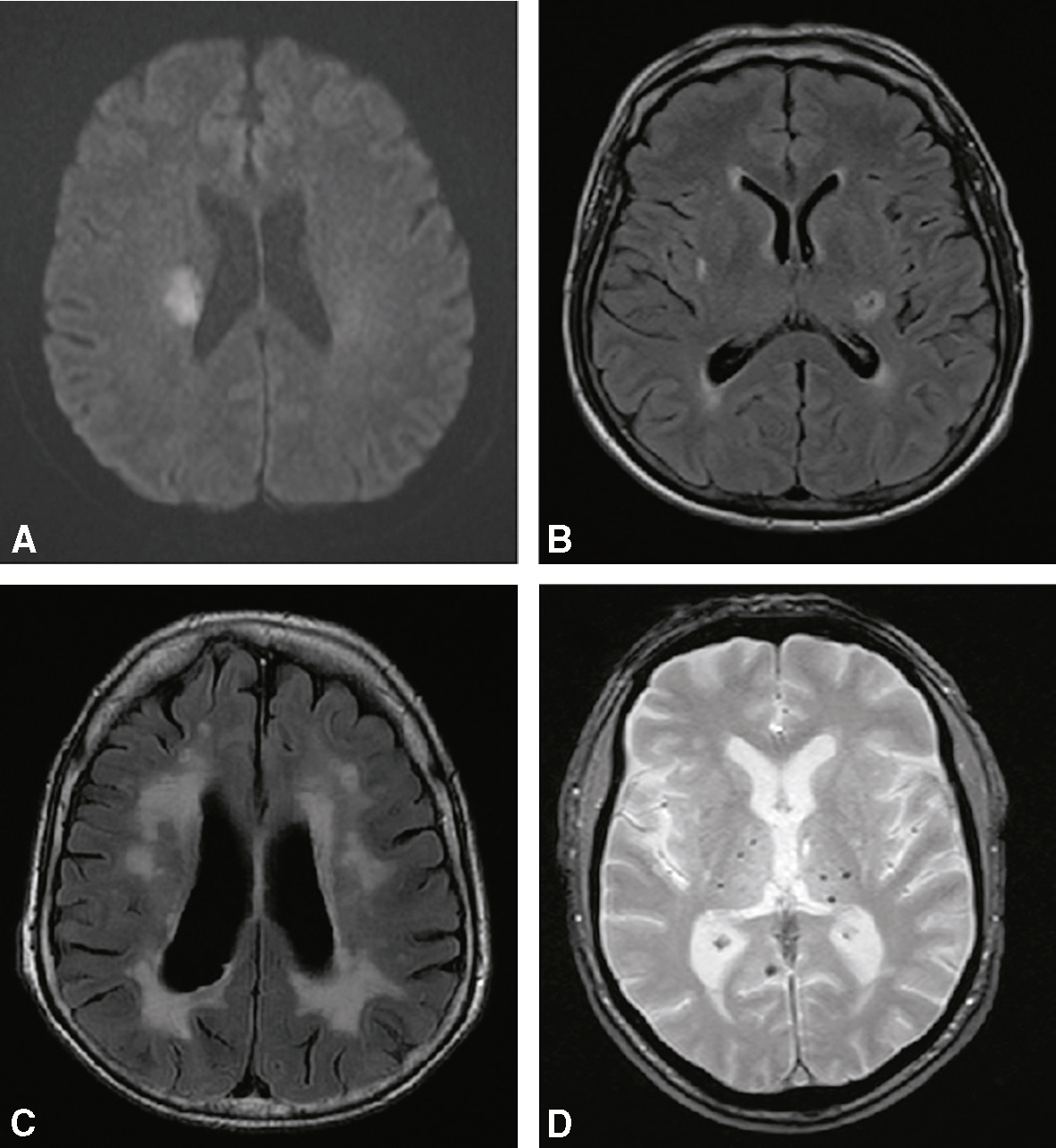 L'infarctus de la circulation postérieure prive le cerveau d'oxygène. Les IRM montrent des zones claires d'infarctus, indiquant des dommages cérébraux dans des régions cruciales.