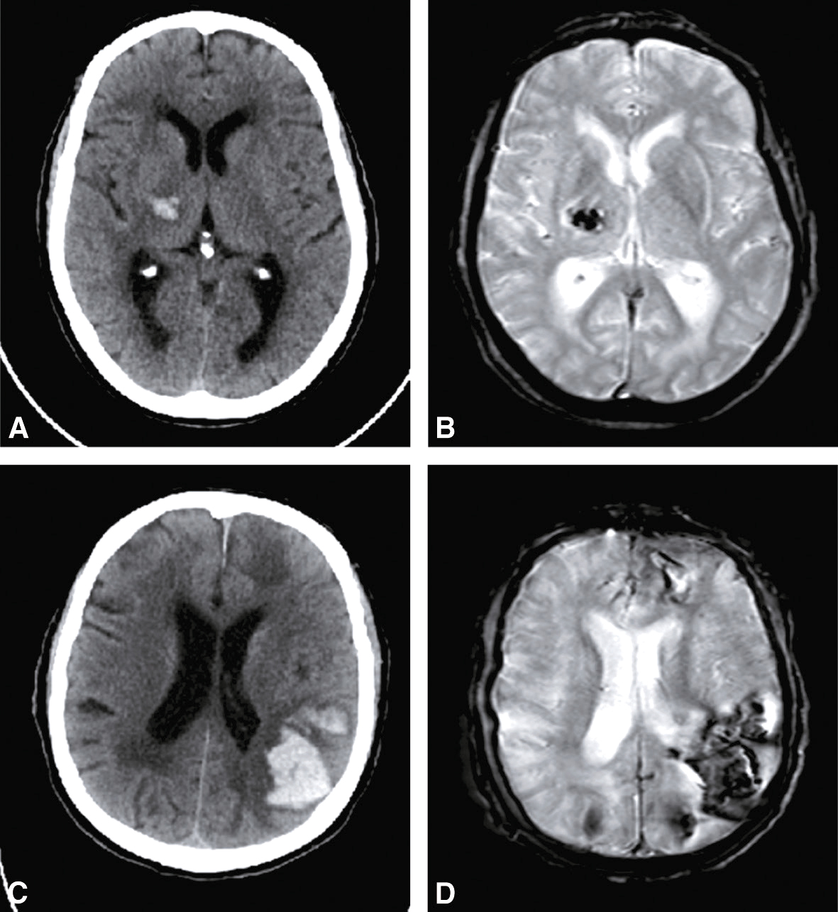 La microangiopathie cérébrale affecte les petits vaisseaux du cerveau. Les IRM montrent des lésions hyperintenses, des hyperintensités de la substance blanche, et des microhémorragies.