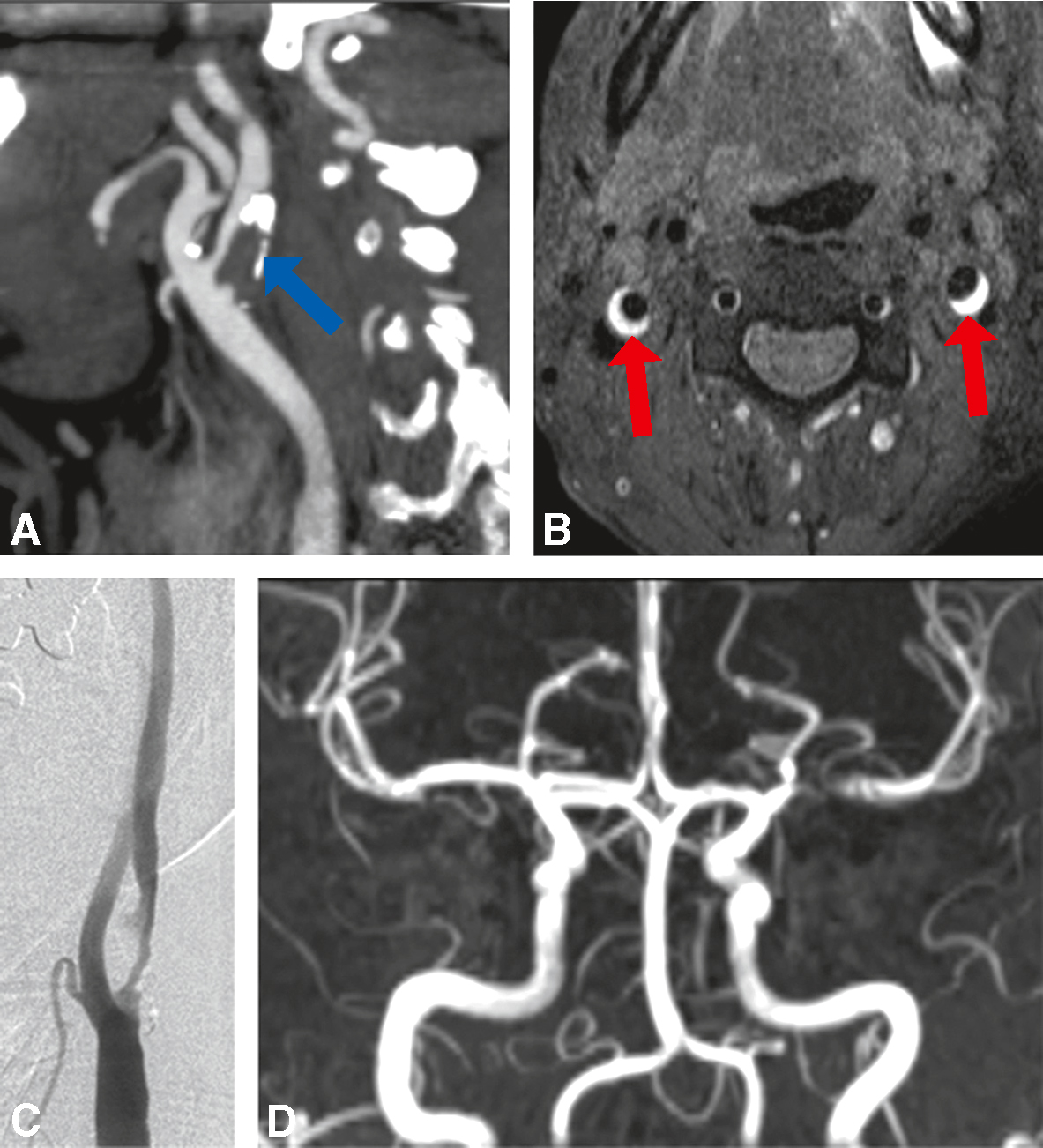 Le diagramme montre les causes des AVC : 20 % hémorragiques et 80 % ischémiques. Les causes ischémiques incluent l'athérosclérose, les lacunes, l'embolie cardiaque et des causes inconnues.
