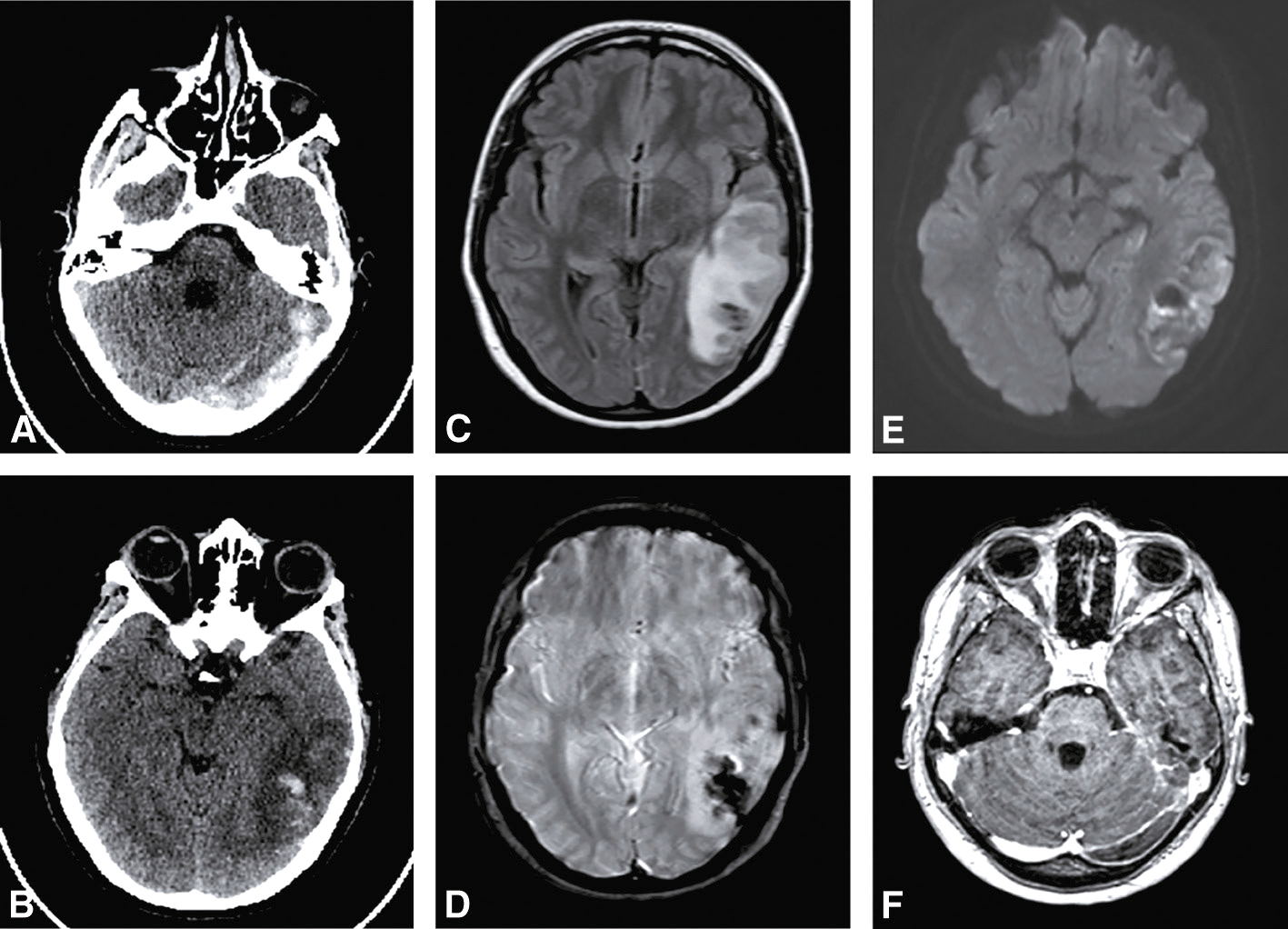 L'image montre différentes techniques d'imagerie des troncs supra-aortiques : angiographie CT, IRM, cathéter et ARM pour évaluer les sténoses des artères carotides.