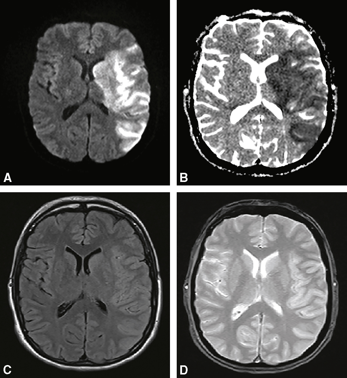 Les images montrent différentes manifestations radiologiques de la thrombose veineuse cérébrale (TVC) sur CT et IRM, mettant en évidence les caillots, œdèmes et infarctus cérébraux.