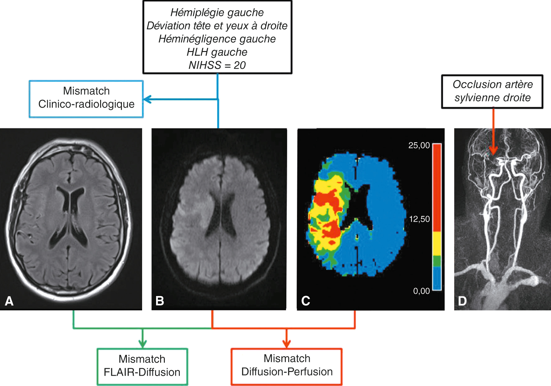 Les images de TDM montrent des signes précoces d'ischémie cérébrale : perte de différenciation entre la substance grise et blanche, et hypodensité dans le territoire cérébral.Les signes précoces d’ischémie cérébrale en scanner sans injection peuvent être identifiés par plusieurs caractéristiques visibles sur les images de tomodensitométrie (TDM). L’ischémie cérébrale est une condition où le flux sanguin vers une partie du cerveau est réduit, entraînant un manque d'oxygène et de nutriments nécessaires au bon fonctionnement des cellules cérébrales. Sur l'image A, on observe une coupe axiale d'un scanner cérébral sans injection de produit de contraste. Cette image montre une densité normale des tissus cérébraux sans signes évidents d'ischémie. L'image B présente également une coupe axiale d'un scanner cérébral sans injection. Un signe précoce d’ischémie cérébrale visible ici est la perte de différenciation entre la substance grise et la substance blanche, indiquée par une flèche bleue. Cette perte de différenciation est due à l'œdème cytotoxique qui se produit lorsque les cellules cérébrales commencent à gonfler en raison du manque d'oxygène. L'image C montre une autre coupe axiale d'un scanner cérébral sans injection. Un autre signe précoce d’ischémie cérébrale est la présence d'une hypodensité dans le territoire de l'artère cérébrale moyenne, indiquée par une flèche rouge. Cette hypodensité représente une zone de tissu cérébral qui a une densité plus faible que le tissu environnant, suggérant une réduction du flux sanguin et un début de nécrose cellulaire. Ces signes précoces d’ischémie cérébrale sont cruciaux pour un diagnostic rapide et précis, permettant une intervention médicale appropriée pour minimiser les dommages cérébraux et améliorer les chances de récupération du patient.